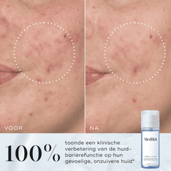 Tranexaminezuur-verheldert-egaliseert-teint