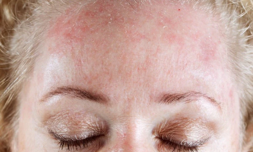 rosacea-gezicht-verminderen